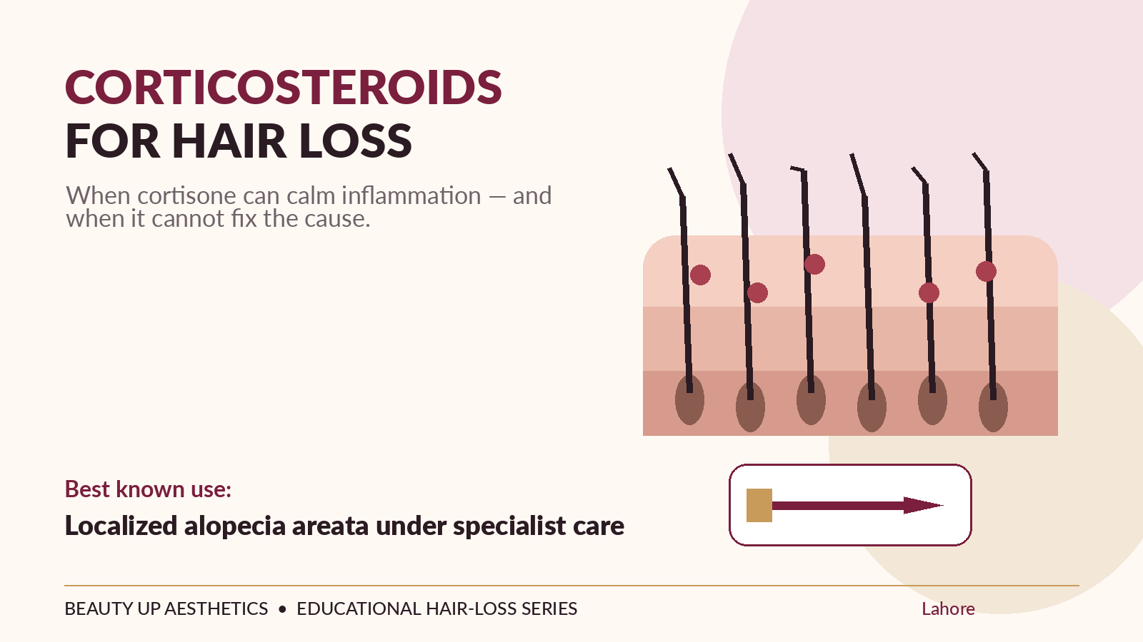Corticosteroids for hair loss illustration showing inflamed scalp follicles and localized cortisone treatment