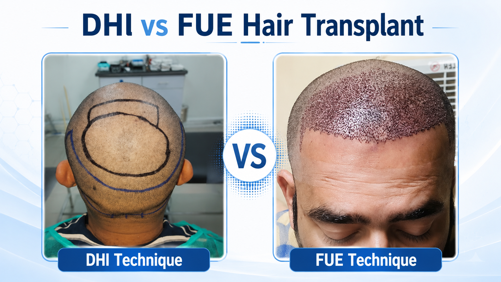 DHI vs FUE hair transplant treatment in Lahore