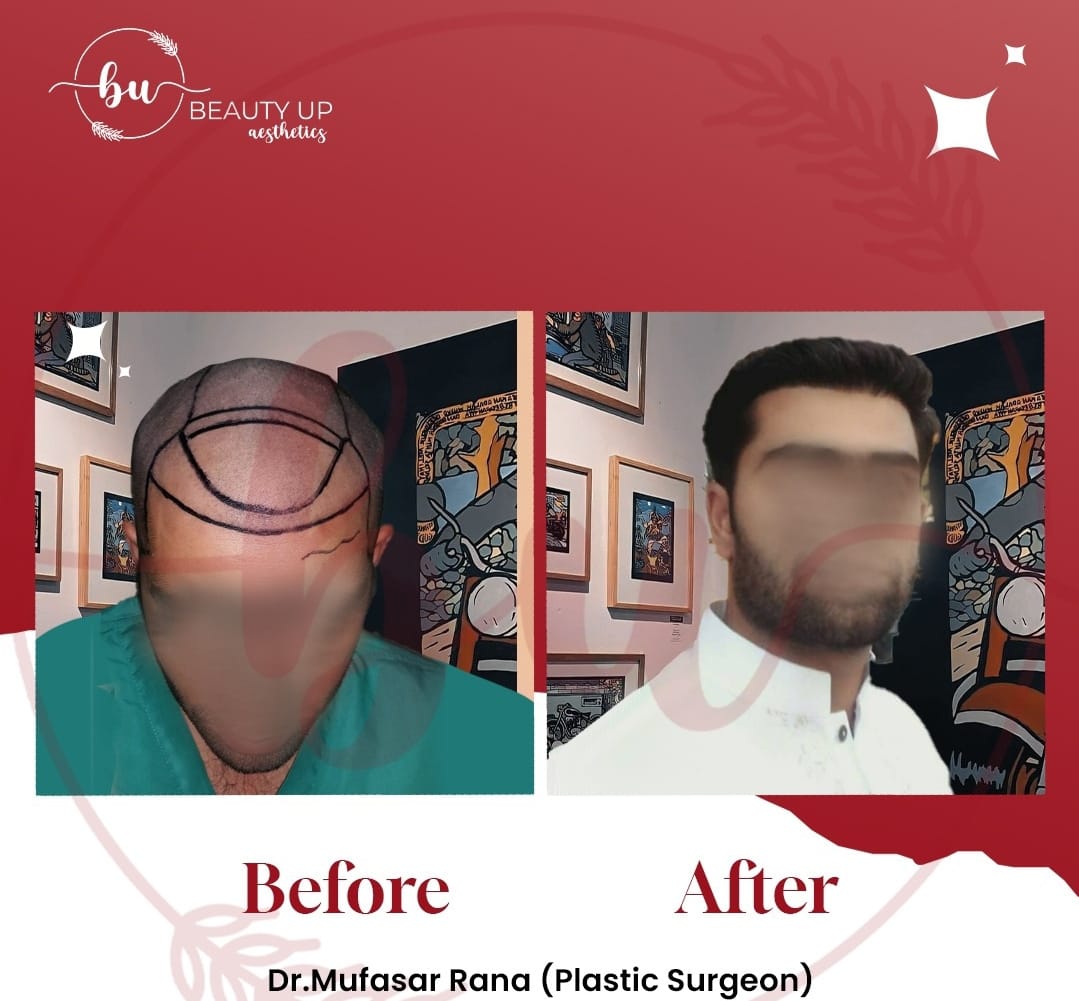 Cosmetic surgery consultation at Beauty Up Aesthetics — nose job rhinoplasty Lahore