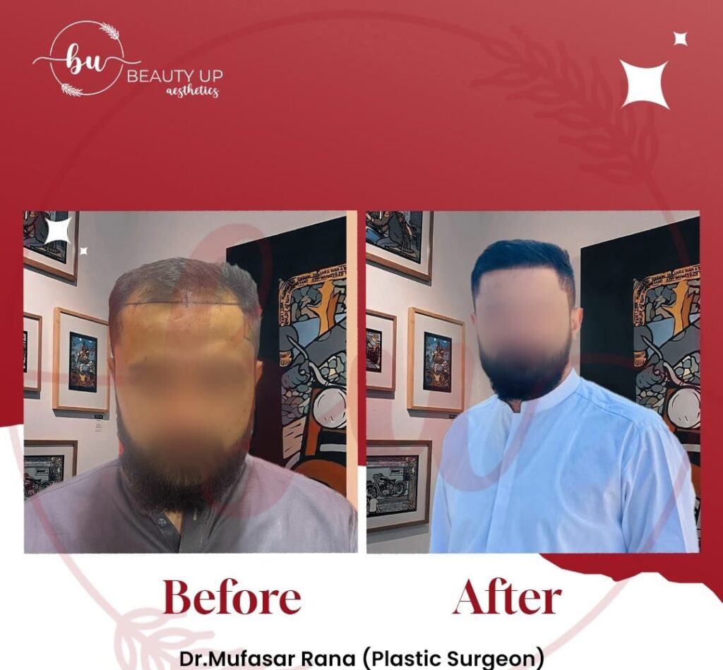 Hair restoration results at Beauty Up Aesthetics — exosome hair treatment in Lahore