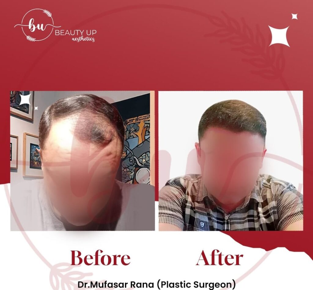 Hair treatment results at Beauty Up Aesthetics — exosome therapy cost guide Lahore