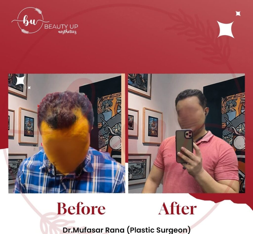 Female hair restoration results at Beauty Up Aesthetics, Lahore
