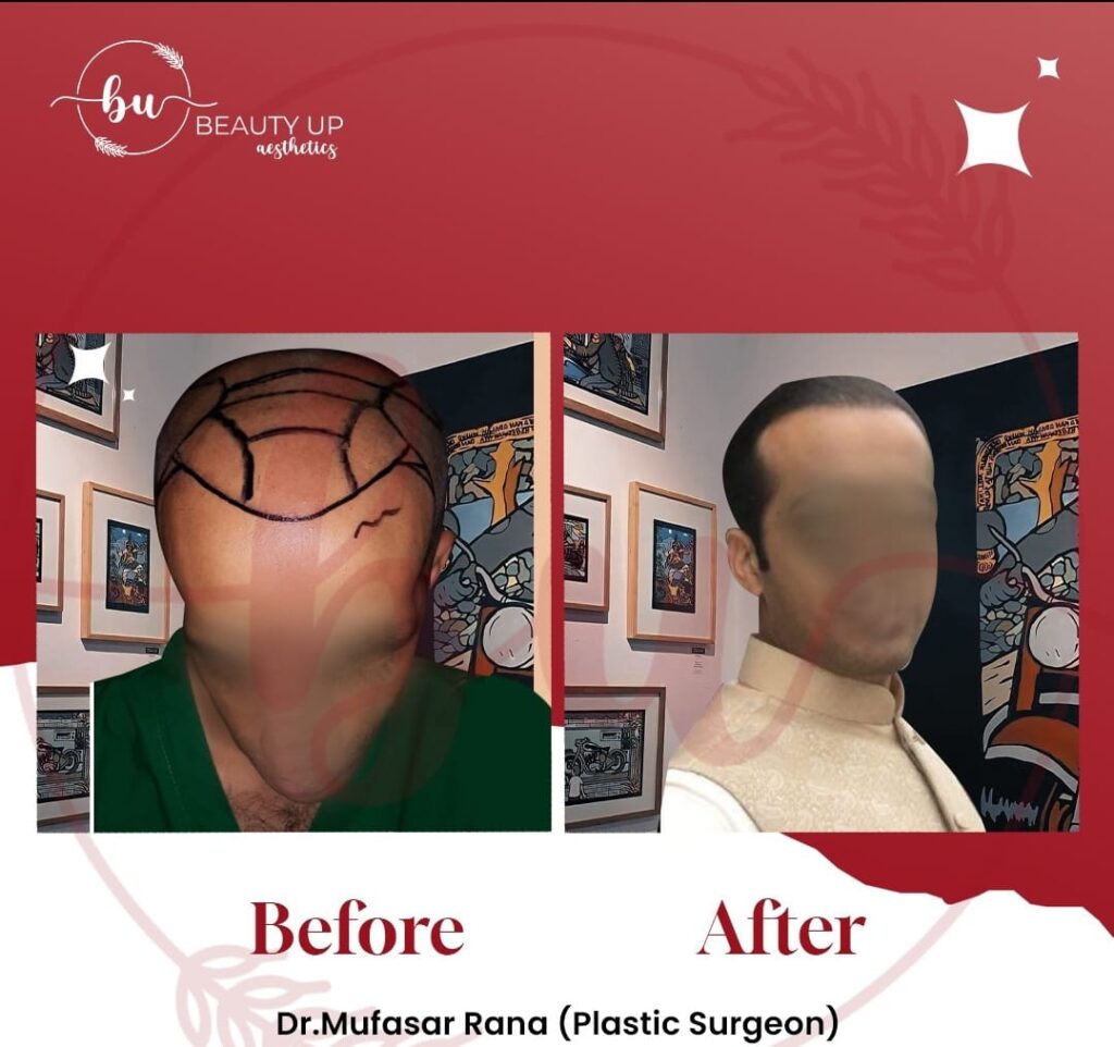 FUT hair transplant results in Lahore at Beauty Up Aesthetics