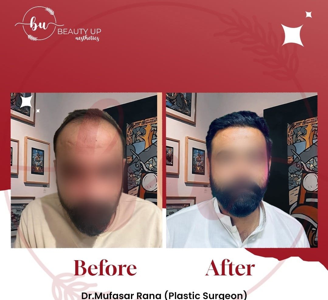 Aesthetic treatment results at Beauty Up Aesthetics — dermal fillers in Lahore