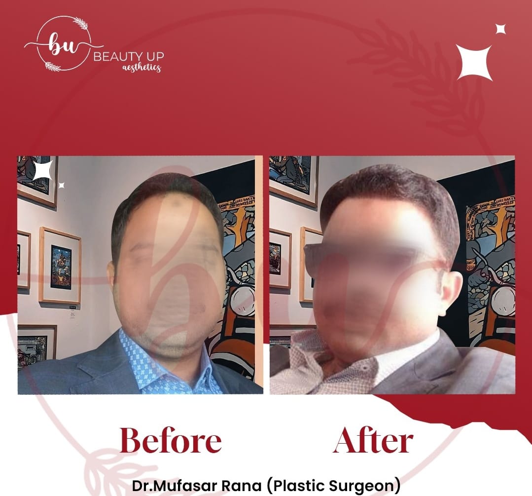 Skin treatment at Beauty Up Aesthetics — HydraFacial in Gulberg Lahore